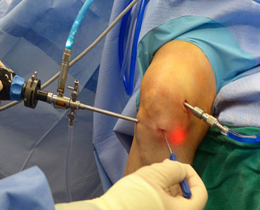 Arthroscopy