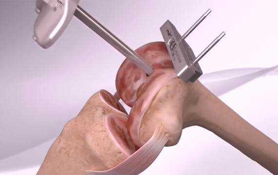 Treatment Video